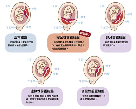 懷孕 胎盤